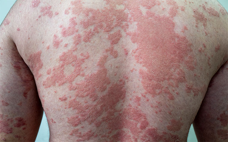 Oral IL-23 inhibitor JNJ-77242113 effective in moderate to severe psoriasis