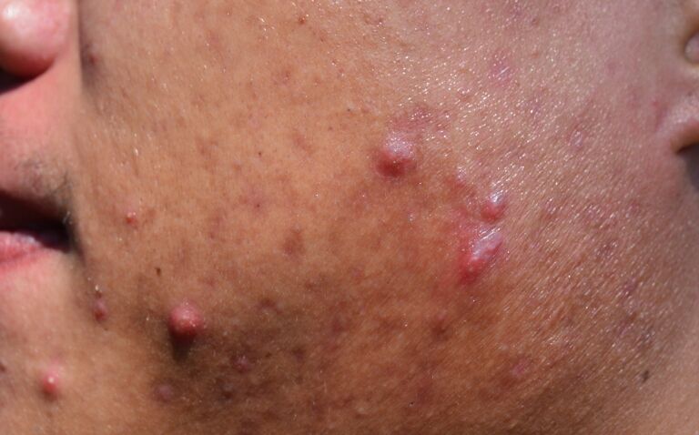 Oral isotretinoin confirmed as most effective treatment for acne in network meta-analysis