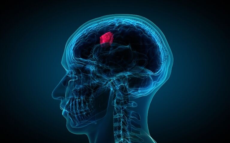 Personalising peptide vaccines for treating glioblastoma: real-world evidence