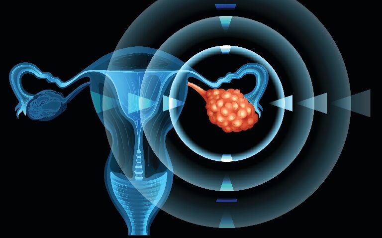 Positive CHMP opinion for rucaparib in advanced ovarian cancer