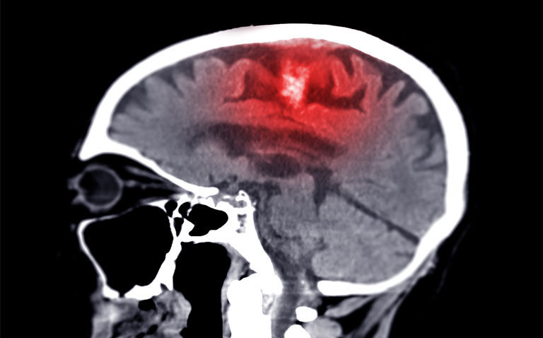 Potential treatment route for vascular dementia uncovered by UK researchers