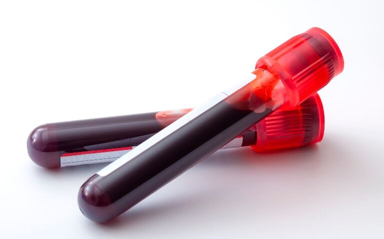 Vials of blood for a blood test to identify ctDNA in lung adenocarcinoma