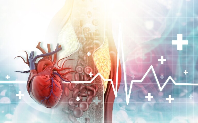 Cholesterol blocked artery with a human heart and ecg trace overlaid and pharmacy crosses in the background to represent early ezetimibe initiation with statins after myocardial infarction improving prognosis