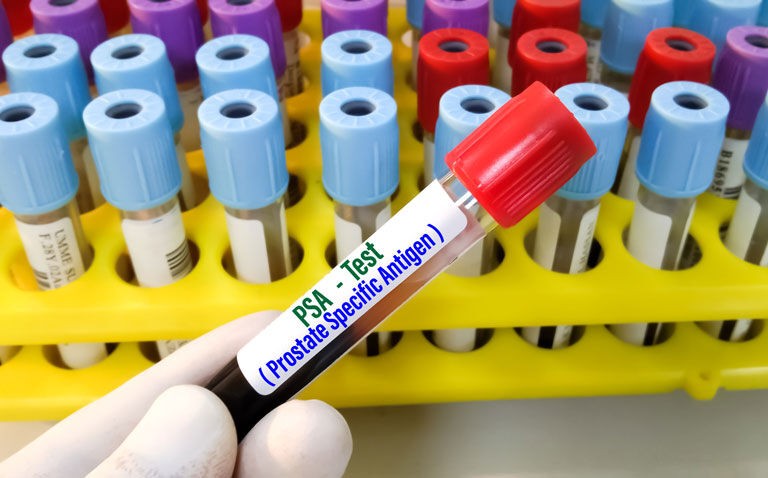 Prostate cancer mortality no different in trial of three treatment interventions