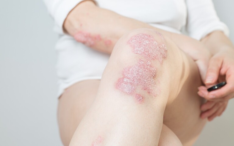 A woman wearing a white top and shorts sitting on a chair with her legs crossed and psoriasis visible on her legs and arms to illustrate the finding that tildrakizumab has positive impact on psychological wellbeing in psoriasis