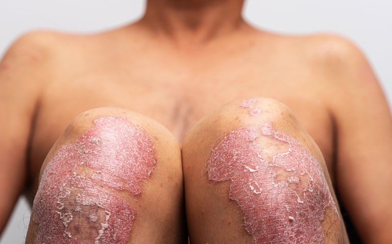 RCT finds oral vitamin D fails to improve disease severity in psoriasis