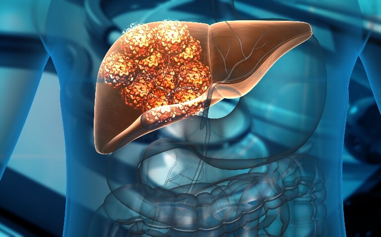 A digital 3D illustration of a human body with the liver highlighted in brown and showing liver cancer cell growth to illustrate uveal melanoma liver metastases and what oncologists need to know about the latest treatments