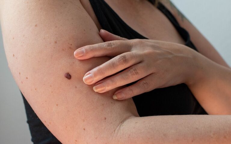 Reinforcement learning AI model improves accuracy of skin cancer diagnoses