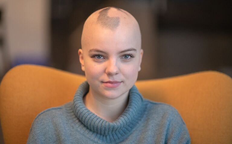 Ritlecitinib recommended by NICE as first drug to treat severe alopecia areata