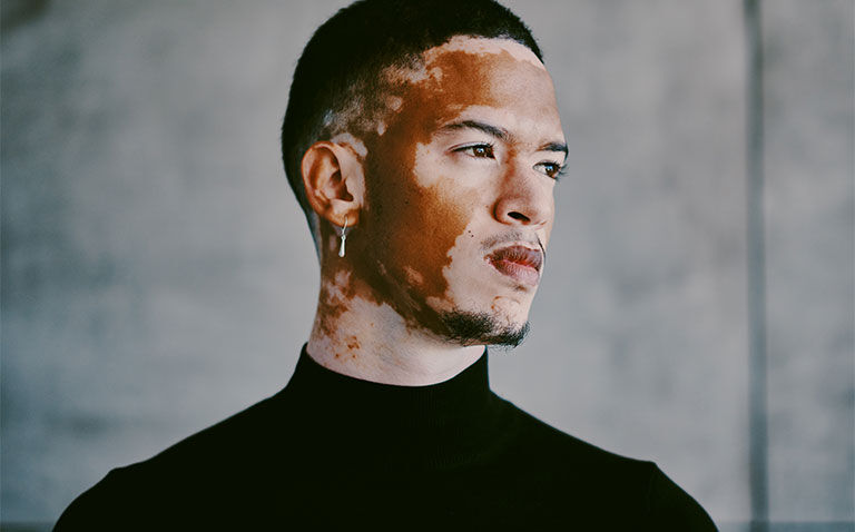 Ruxolitinib cream approved by MHRA for non-segmental vitiligo