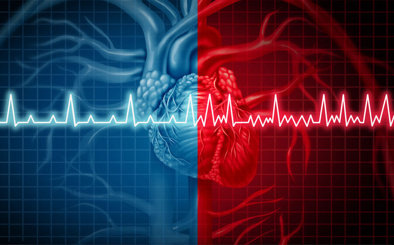 SGLT-2 inhibition lowers stroke risk in diabetics with atrial fibrillation