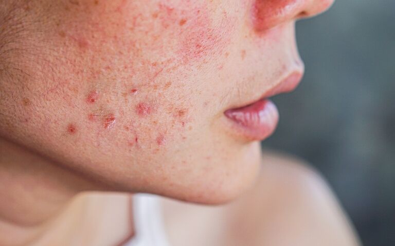 Spironolactone safe and effective for treating acne in women