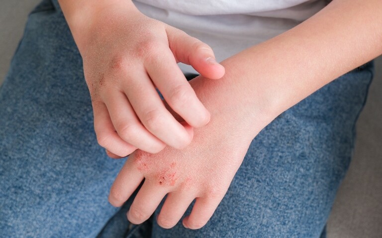A close up of a young boy with his hands crossed across his lap and contact allergic dermatitis on his knuckles to illustrate the proposal of a standardised allergen patch test panel for children as part of the European Baseline Series