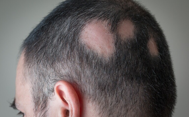 A man looking away from the camera with spots of alopecia areata visible on the side and back of his head to illustrate new research showing that stigma rather than illness severity drives depression in these patients
