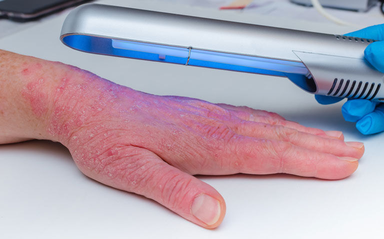 Study finds no increased risk of skin cancer from UVB phototherapy for atopic eczema