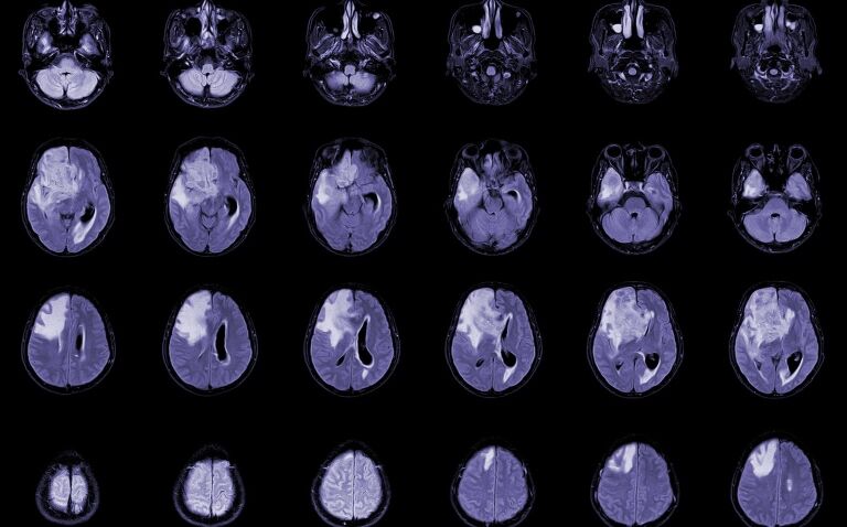 Synthetic lipid derived from olive shows early promise for glioblastoma patients