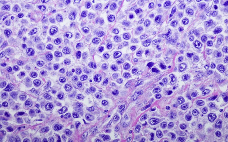T cell biomarker predicts CAR T cell therapy response in relapsed lymphoma