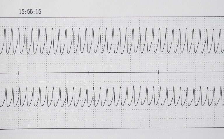 A heart trace showing ventricular tachycardia to illustrate a study's findings that a temperature-controlled ablation system is safe and effective