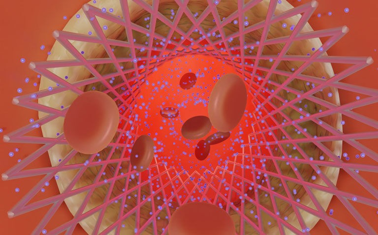 Ticagrelor reduces MACE compared to clopidogrel following stent implant