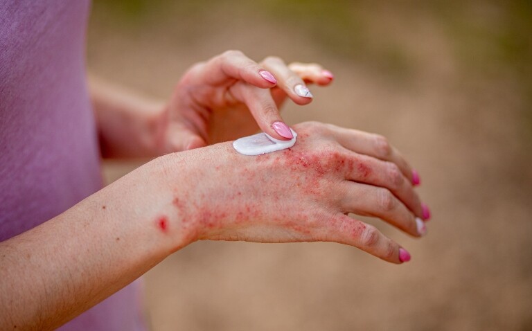 A close up of a woman applying topic treatment to chronic hand eczema to illustrate the results of a new real-world review