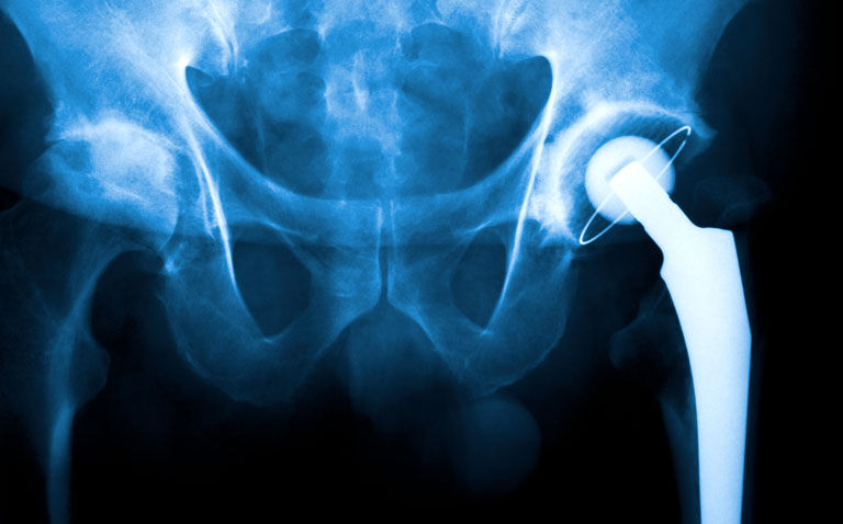 Use of colchicine associated with reduced risk of knee and hip replacement in osteoarthritis