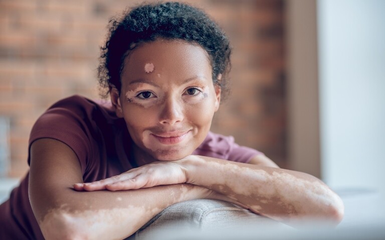 A young woman with vitiligo on her face and arms leaning on her hands and smiling at the camera to illustrate an interview with Associate Professor Viktoria Eleftheriadou