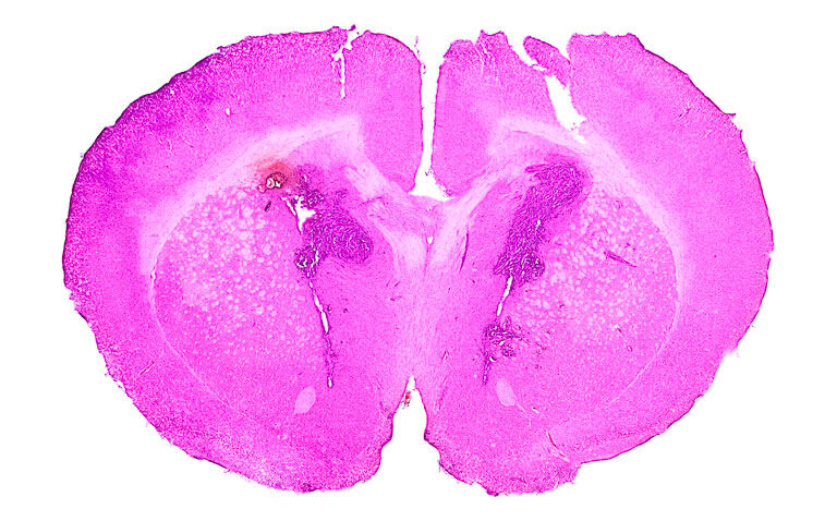 Vorasidenib found to improve progression-free survival in IDH–mutant grade 2 gliomas