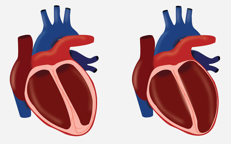 Two cross-section diagrams of a human heart with the left showing a normal heart and the right showing dilated cardiomyopathy