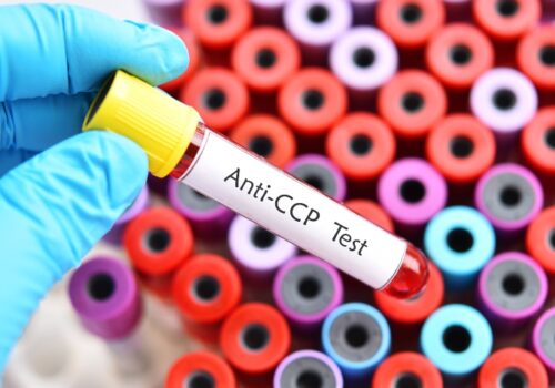 A birds eye view of a rack of test tubes with a gloved hand holding a test tube of blood over the top with the label Anti-CCP Test to illustrate the finding that early abatacept treatment delays rheumatoid arthritis onset in at-risk individuals