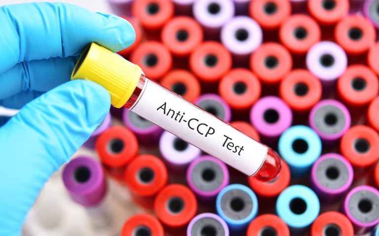 A birds eye view of a rack of test tubes with a gloved hand holding a test tube of blood over the top with the label Anti-CCP Test to illustrate the finding that early abatacept treatment delays rheumatoid arthritis onset in at-risk individuals