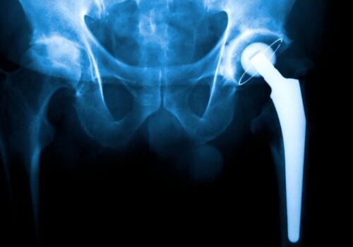 An X-ray showing a hip replacement to illustrate that the procedure for osteoarthritis can lead to complications based on deprivation