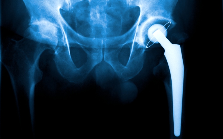 An X-ray showing a hip replacement to illustrate that the procedure for osteoarthritis can lead to complications based on deprivation
