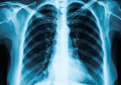 AI model predicts CVD risk from single chest radiograph|AI model predicts CVD risk from single chest radiograph