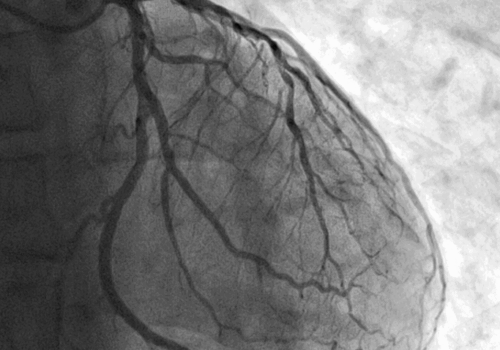 AI read chest radiographs help to identify severe CAD