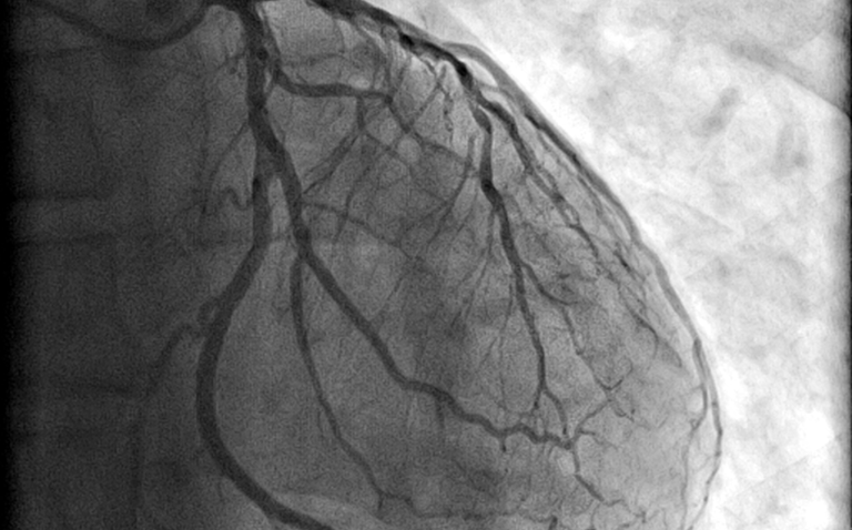AI read chest radiographs help to identify severe CAD