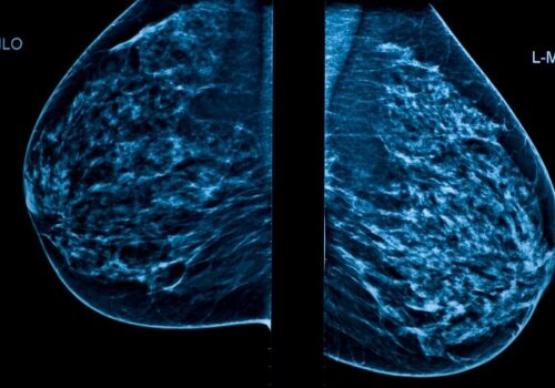 A mammogram image showing left and right breasts to illustrate the finding that AI-supported mammography screening demonstrates non-inferior interval cancer rates in breast cancer