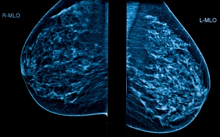 A mammogram image showing left and right breasts to illustrate the finding that AI-supported mammography screening demonstrates non-inferior interval cancer rates in breast cancer