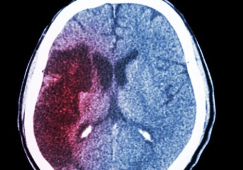 ASPECTS aids decision-making for endovascular therapy in acute ischaemic stroke