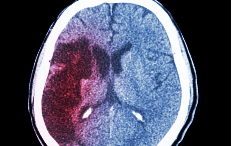 ASPECTS aids decision-making for endovascular therapy in acute ischaemic stroke