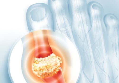 A digital illustration of a foot with a circle highlighted with an inflamed big toe joint to illustrate the finding that achieving recommended serum urate targets in gout lowers risk of MACE