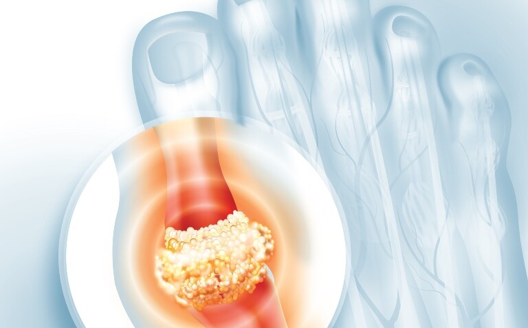 A digital illustration of a foot with a circle highlighted with an inflamed big toe joint to illustrate the finding that achieving recommended serum urate targets in gout lowers risk of MACE