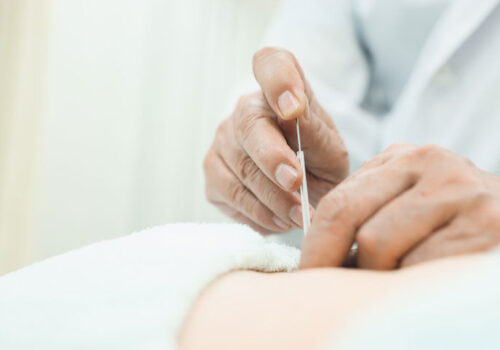 Acupuncture with diclofenac provides substantial and fast pain relief in renal colic