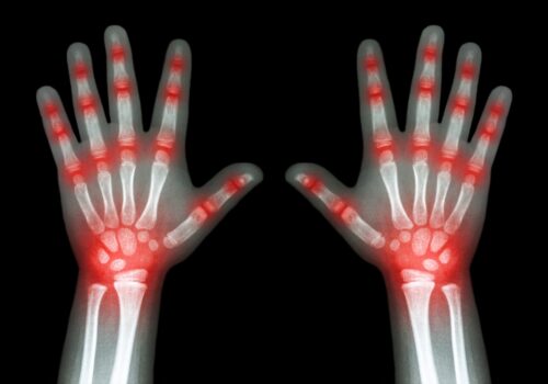 An X-ray of a child's hands with red glowing pain points at each of the finger and wrist joints to represent JIA and ongoing drug shortages