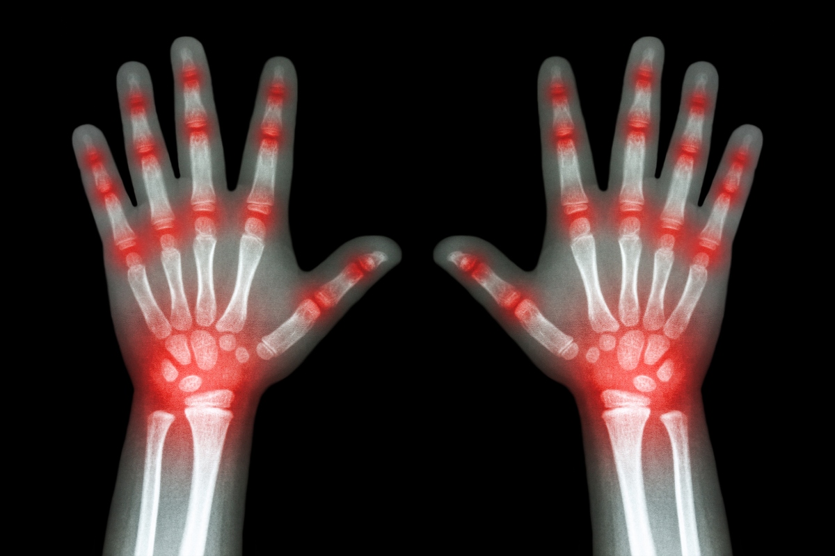 An X-ray of a child's hands with red glowing pain points at each of the finger and wrist joints to represent JIA and ongoing drug shortages
