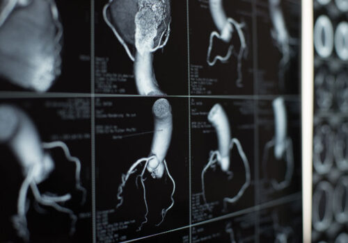 Adding coronary artery calcium scores to CVD risk assessment provides no clinical benefit