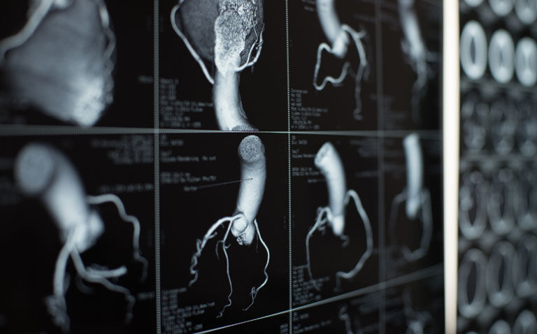 Adding coronary artery calcium scores to CVD risk assessment provides no clinical benefit