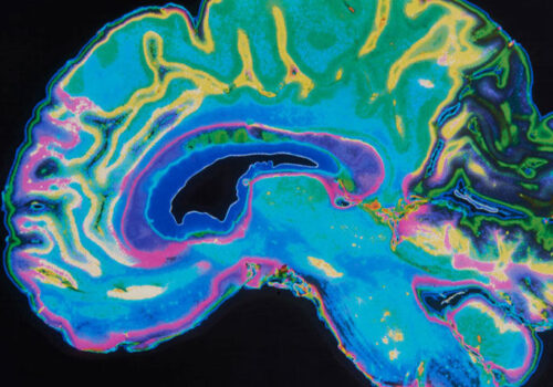 Additional MRI and CT scan does not affect clinical outcomes in acute ischaemic stroke