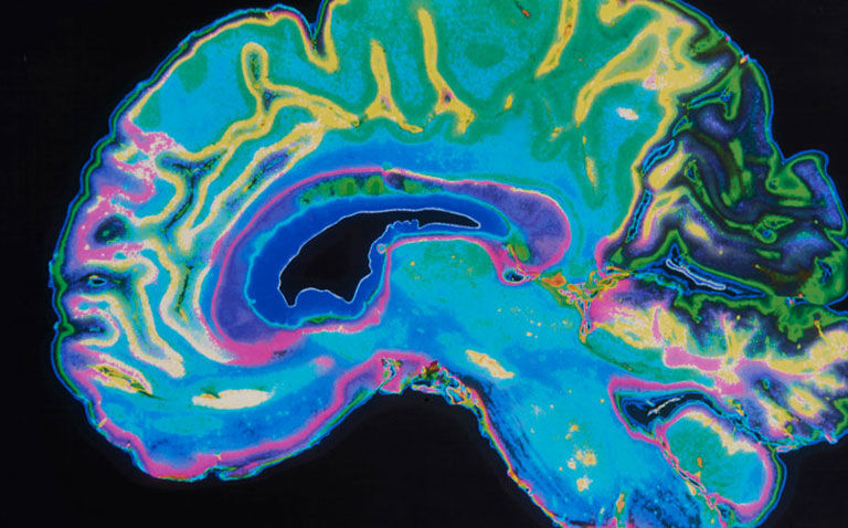 Additional MRI and CT scan does not affect clinical outcomes in acute ischaemic stroke
