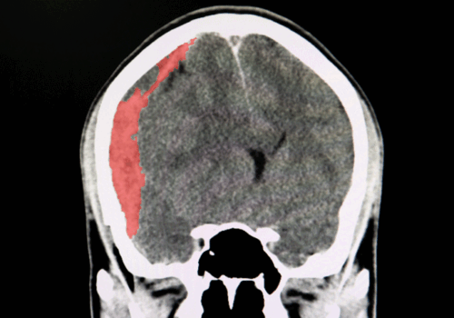 Anticoagulation reversal agents equally effective and safe after intracranial haemorrhage