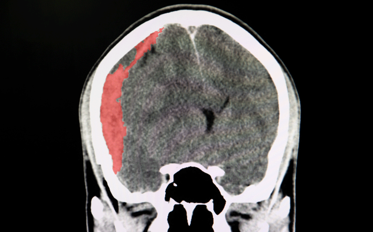 Anticoagulation reversal agents equally effective and safe after intracranial haemorrhage